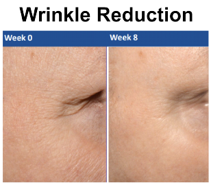 Ceratiq Charts_ceratiq chart wrinkle reduction 1